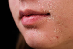 Skin Dryness
